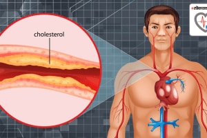 cholesterol range these Six morning habits to lower cholesterol level says cardiologist expert