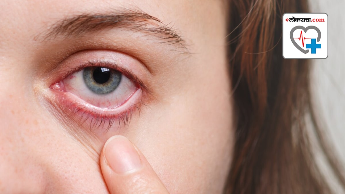 What is dry eyes Disease