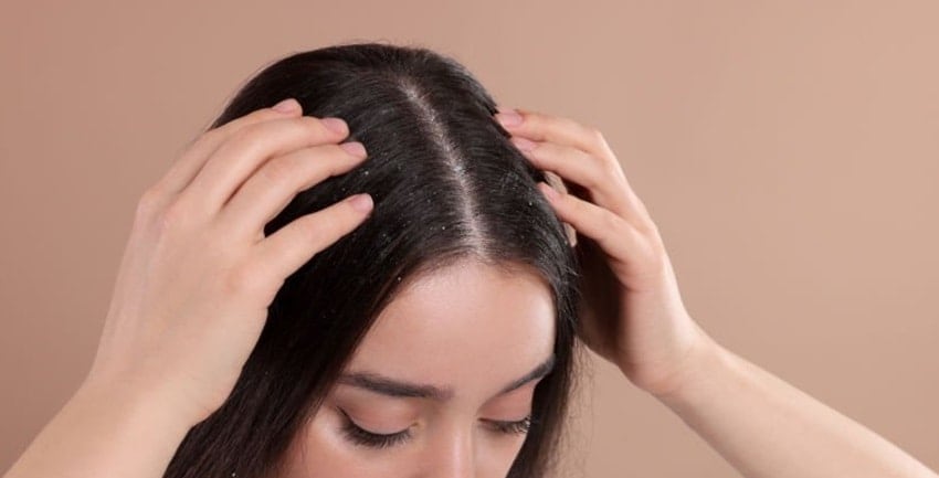 Woman suffering from dandruff problem