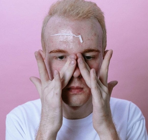 Hormonal acne in men